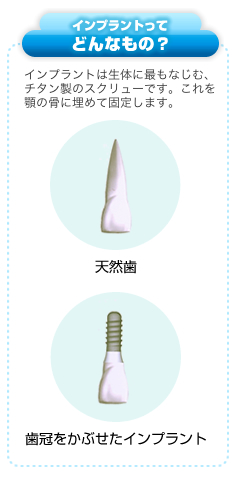 インプラントは生体に最もなじむチタン製のスクリューです。これを顎の骨に埋めて固定します。
