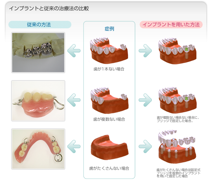 インプラントと従来の治療法の比較