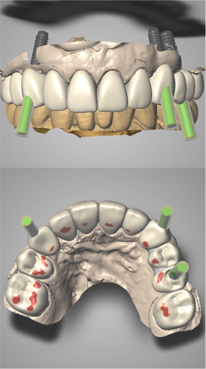 歯の3D画像